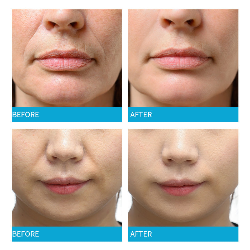 Overnight Nasolabial Fold & Smile Line Patches — 5 Pairs, Hydrogel Sleep Treatment